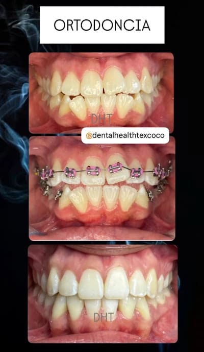 DENTAL HEALTH TEXCOCO