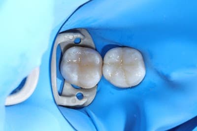 Diseño de Sonrisa en Guadalajara Dra Luly Mata Dentista