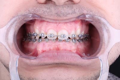 Zental Odontología - Sertoma - Clínica Dental Monterrey